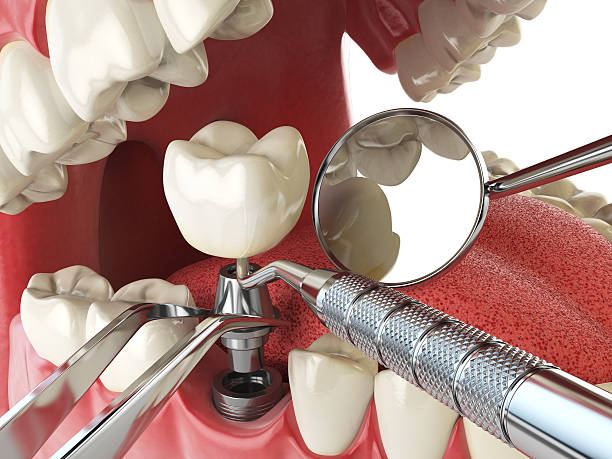 Best Emergency Cosmetic Dentistry (e.g., broken veneers) in Cambridge, MD